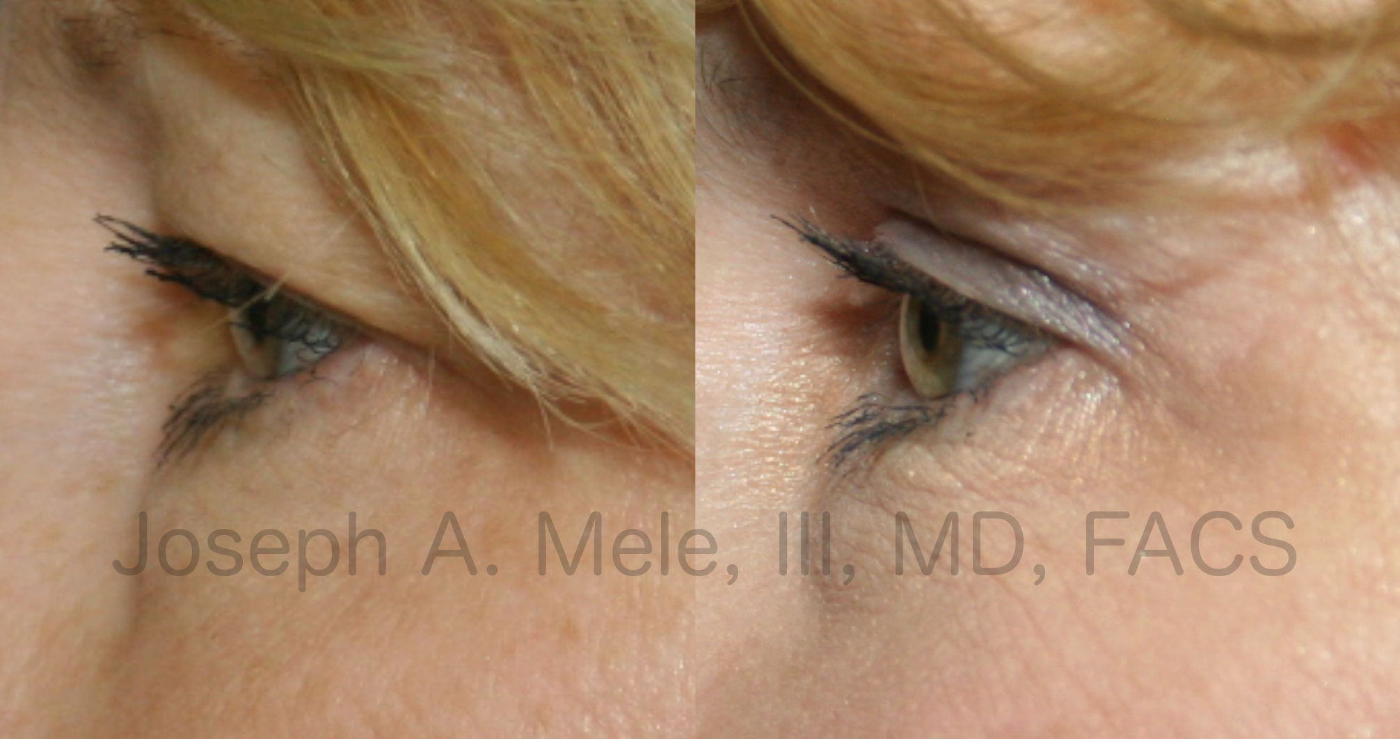 Eyelid Lift before and after pictures (Blepharoplasty)