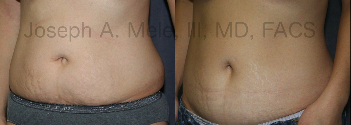 Mini Tummy Tuck Before and After Pictures (Mini Abdominoplasty)