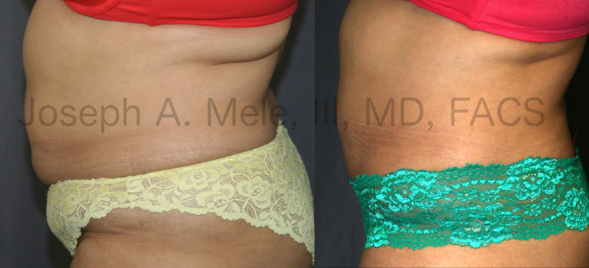 Mini Tummy Tuck Before and After Pictures (Mini Abdominoplasty)
