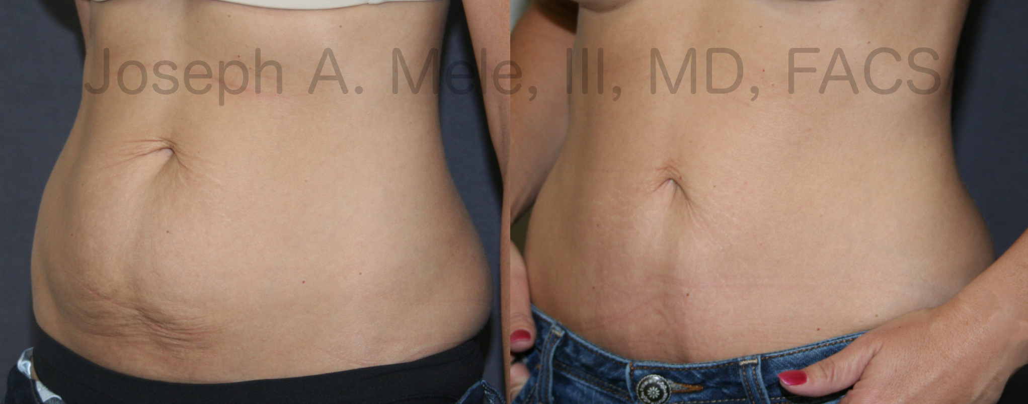 Mini Tummy Tuck