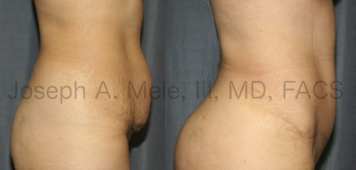 Tummy Tuck Before and After Pictures (Abdominoplasty)
