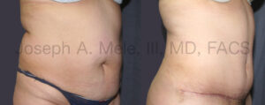 Tummy Tuck Before and After Pictures (Abdominoplasty)
