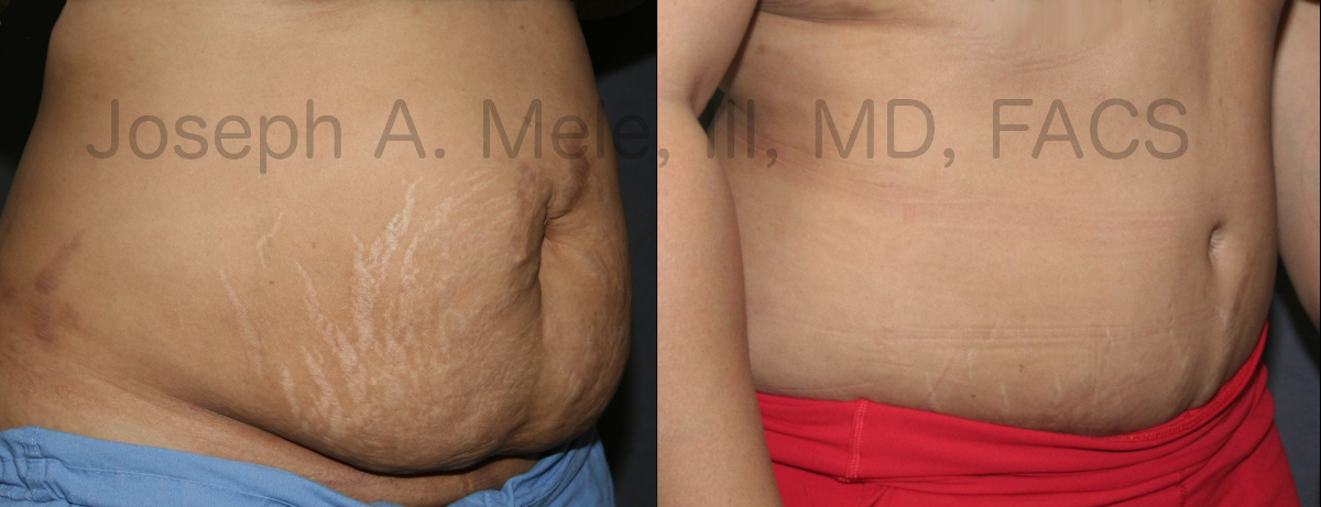 Tummy Tuck Before and After Pictures (Abdominoplasty)