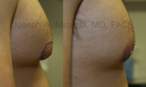 Male Breast Reduction Before and After Pictures - Gynecomastia Before and After Photos