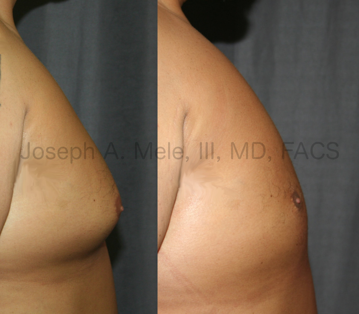 Male Breast Reduction Before and After Pictures - Gynecomastia Before and After Photos