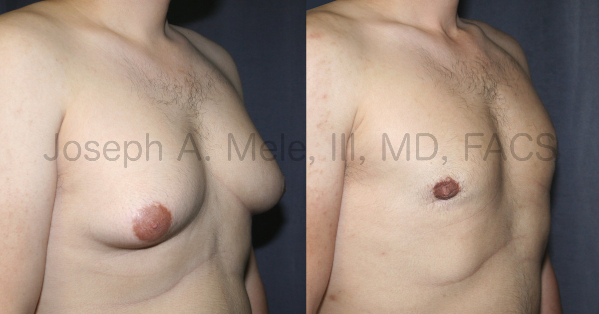 Male Breast Reduction Before and After Pictures - Gynecomastia Before and After Photos