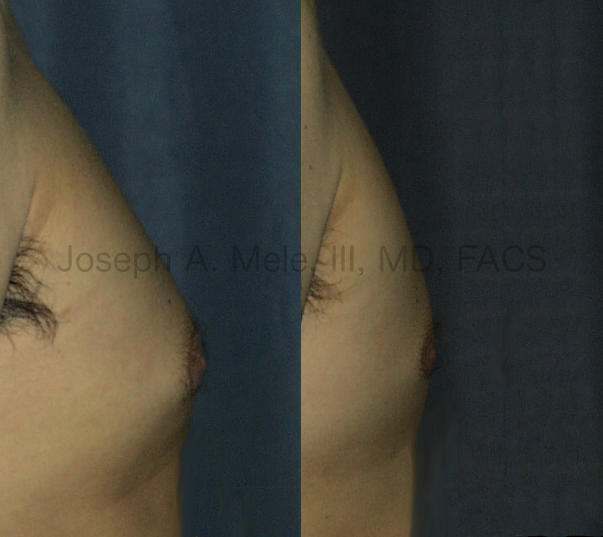 Male Breast Reduction Before and After Pictures - Gynecomastia Before and After Photos