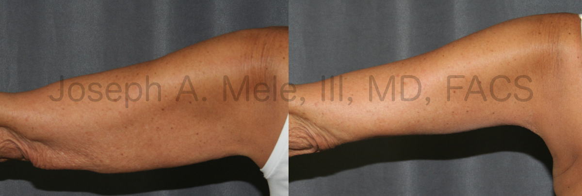 Arm Lift Before and After Photos Brachioplasty