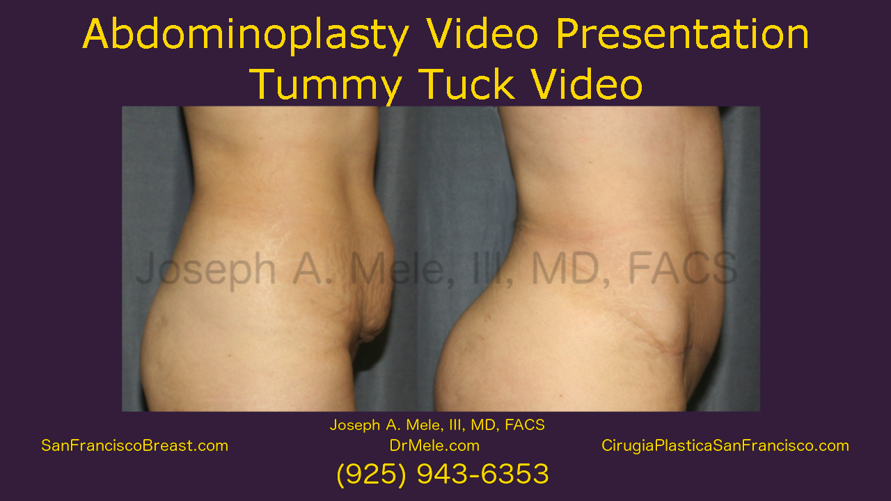 Tummy Tuck before an after pictures Abdominoplasty video presentation