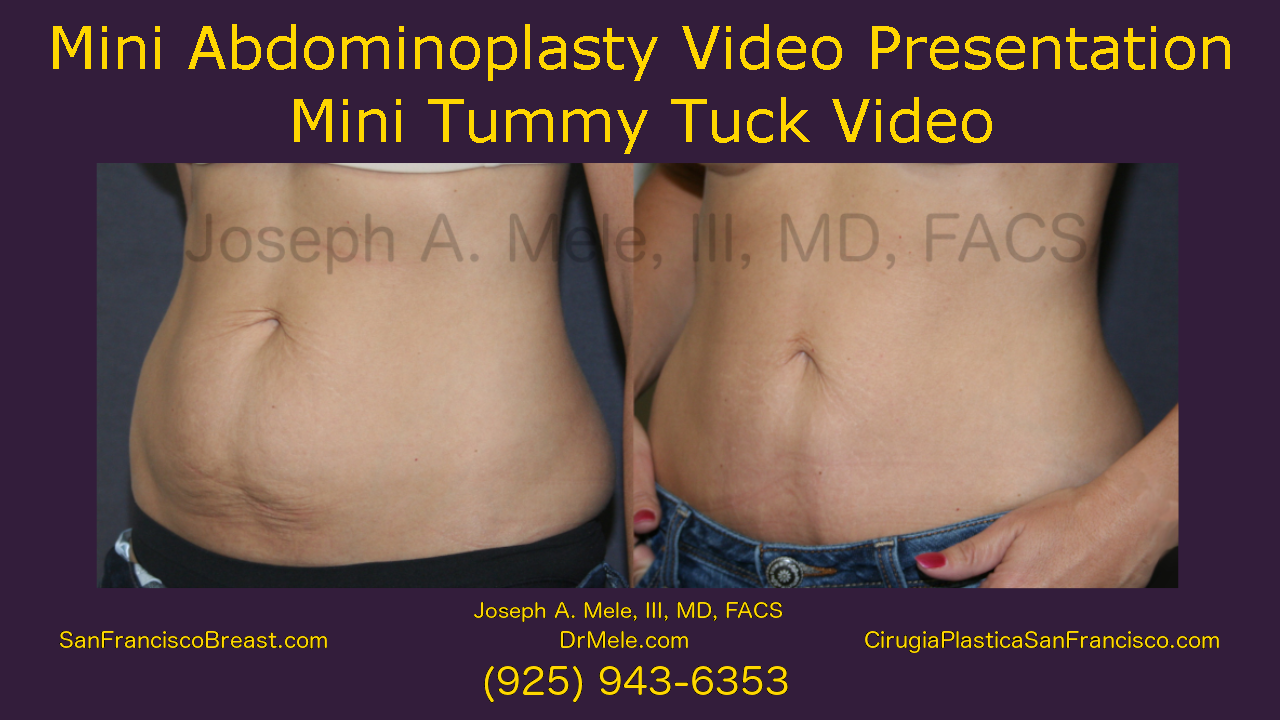 Mini Tummy Tuck before an after pictures Mini Abdominoplasty video presentation