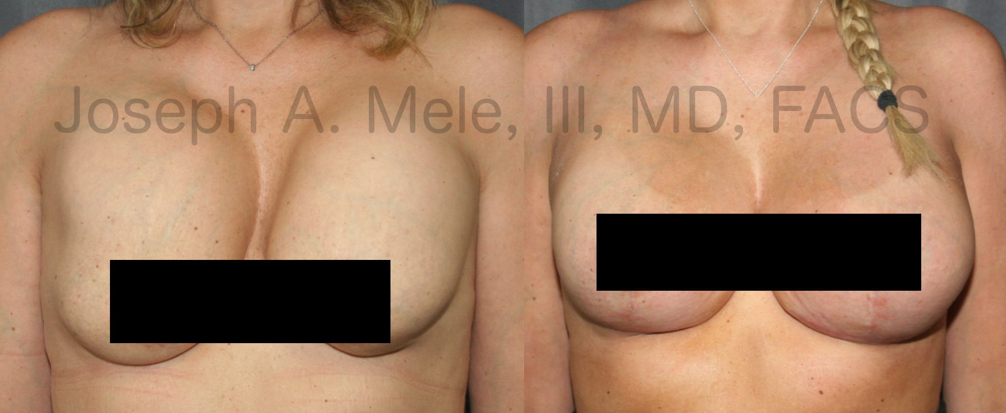 Breast Implant Revision before and after pictures Breast Augmentation Revision surgery