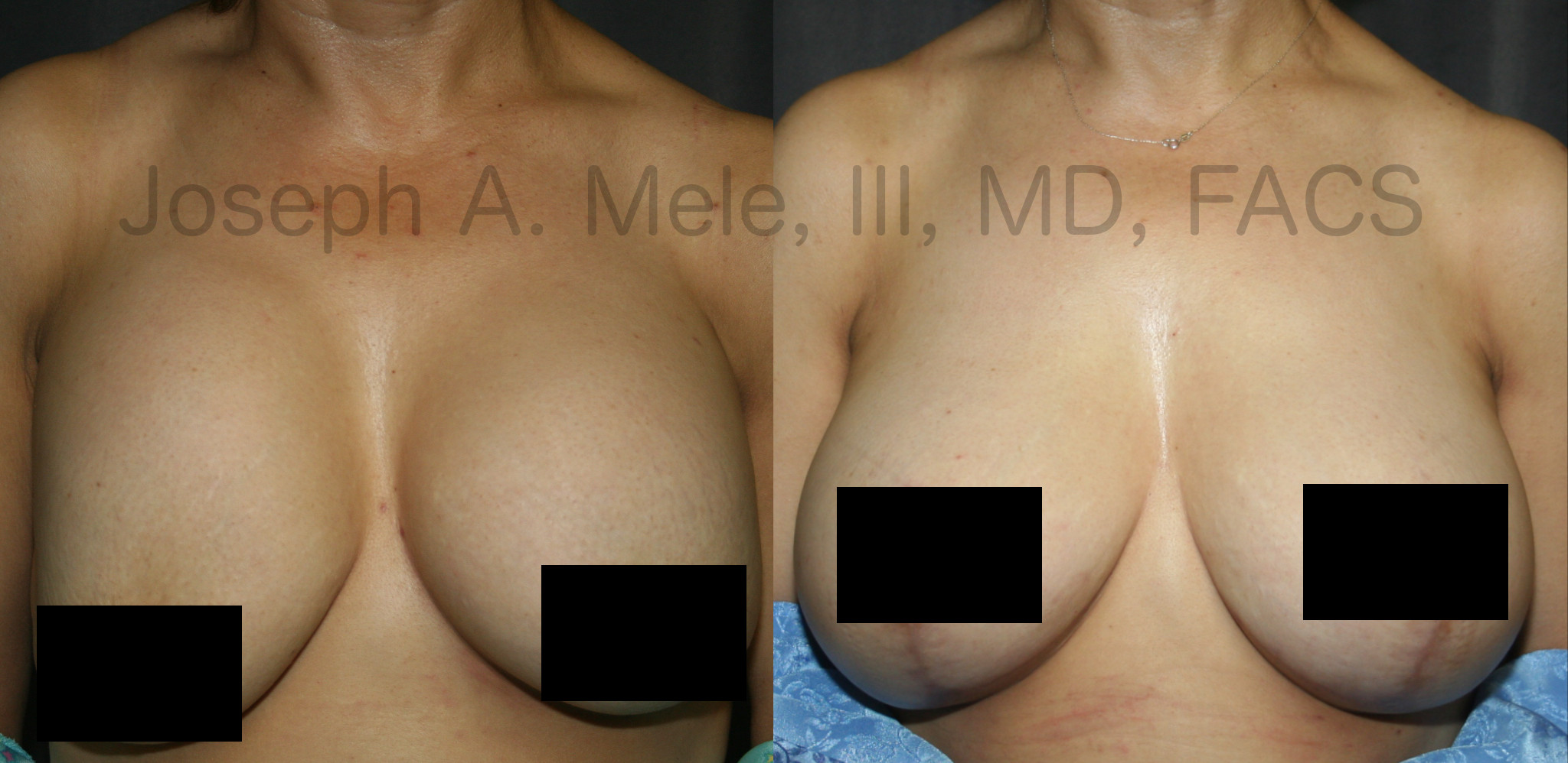 Breast Implant Revision before and after pictures Breast Augmentation Revision surgery