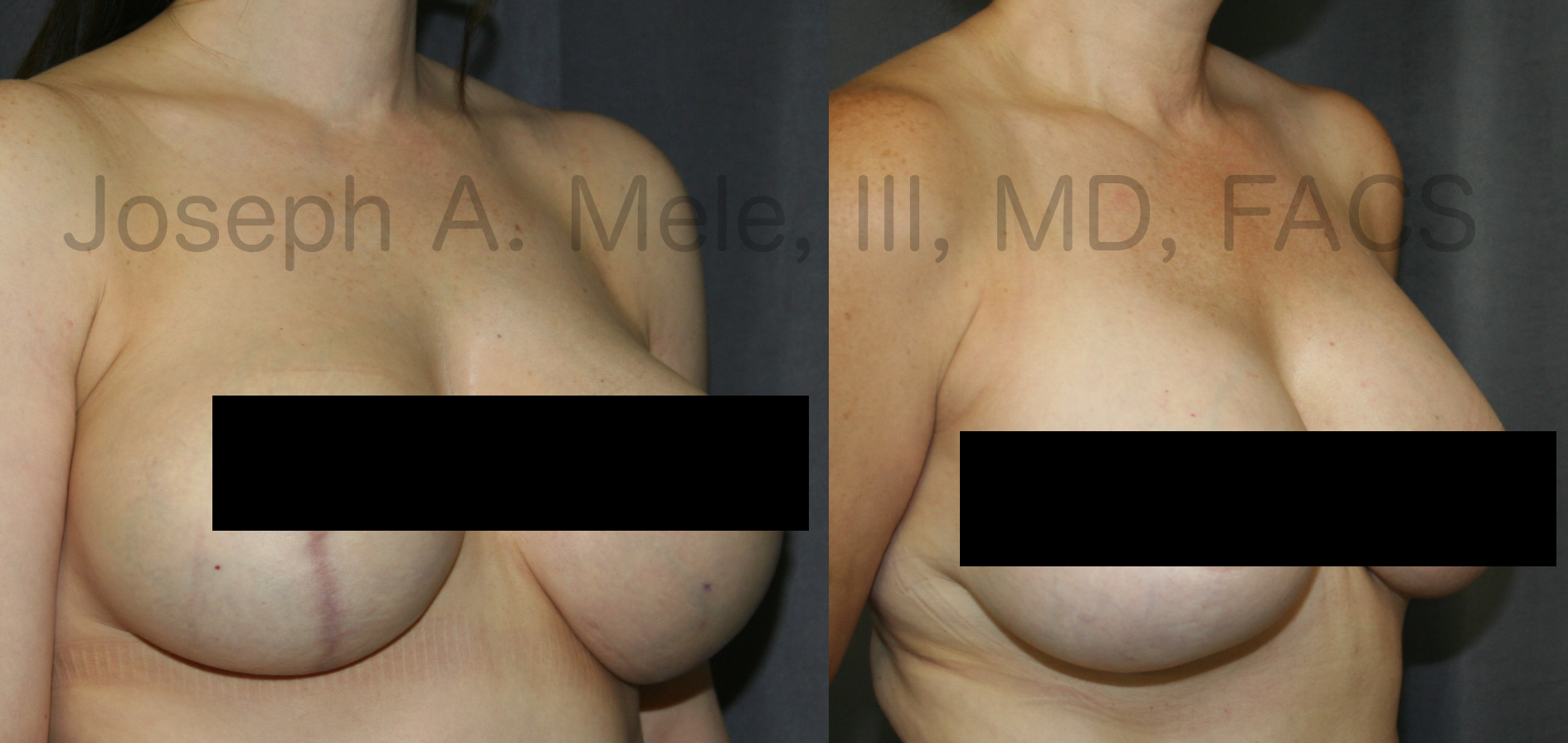 Breast Implant Revision before and after pictures Breast Augmentation Revision surgery