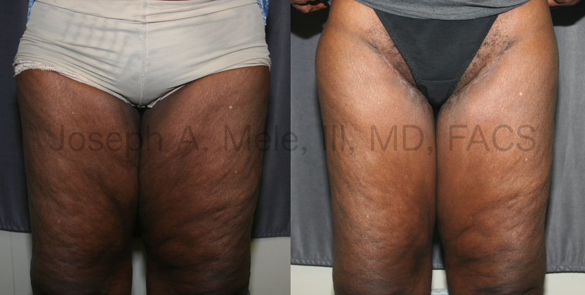 Thigh Lift after Weight Loss (Post-Bariatric Thighplasty) before and after photos