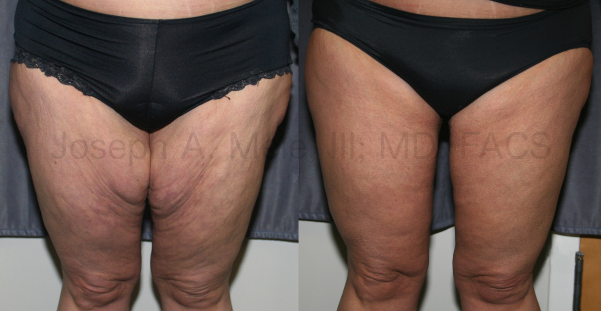 Thigh Lift after Weight Loss (Post-Bariatric Thighplasty) before and after photos