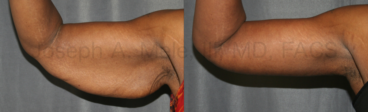Arm Lift Before and After Pictures (Brachioplasty)