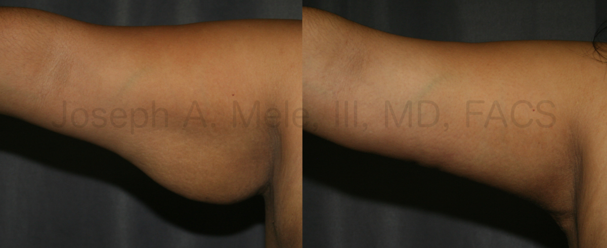 Arm Lift Before and After Pictures (Brachioplasty)