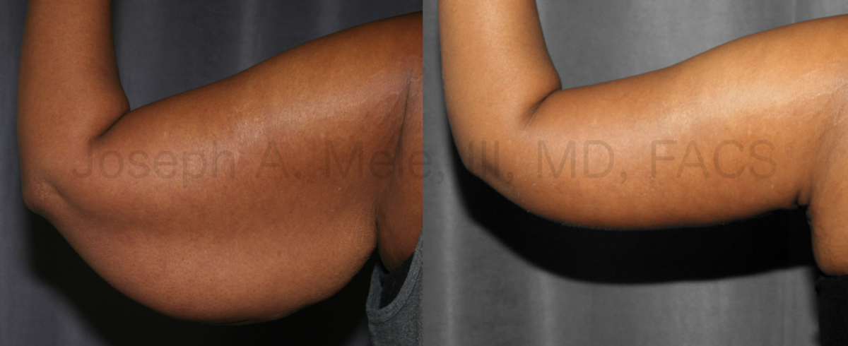 Arm Lift Before and After Pictures (Brachioplasty)