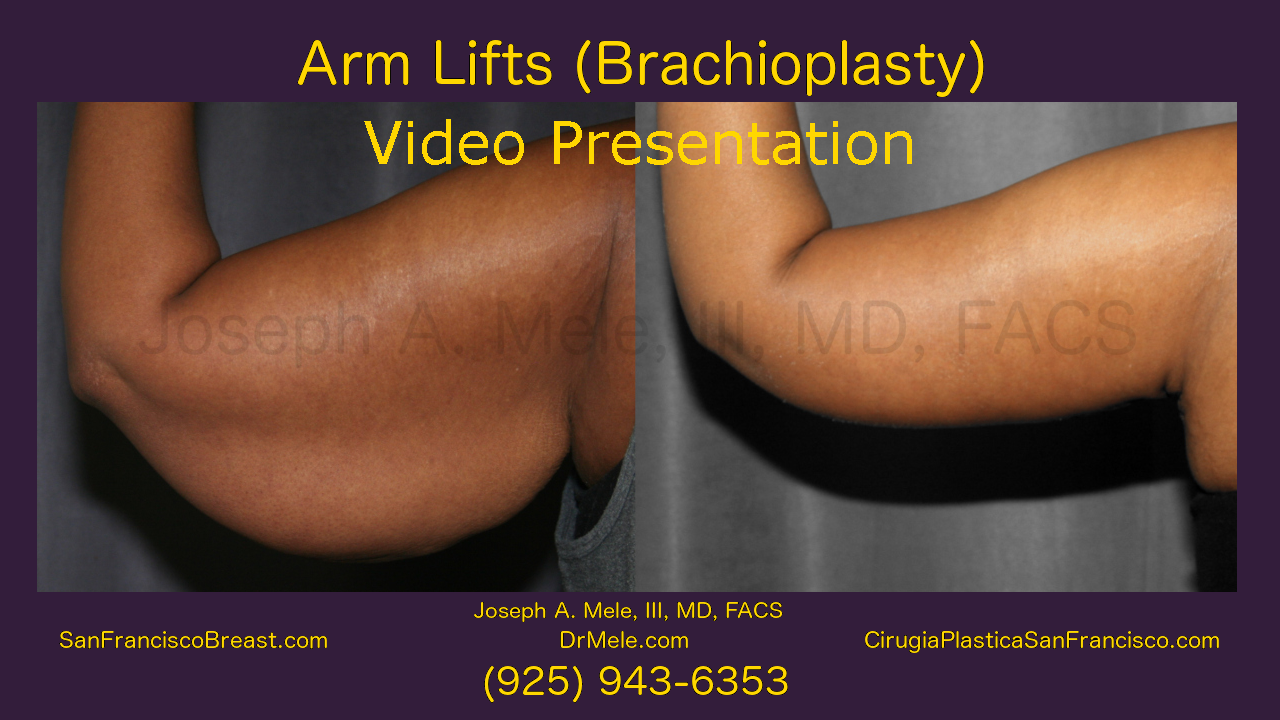 Arm Lift Before and After Pictures (Brachioplasty Video)