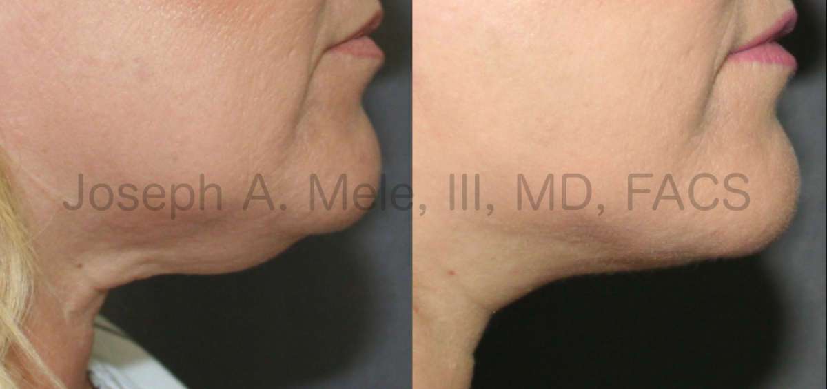 Lipo360 Liposuction before and after pictures - neck
