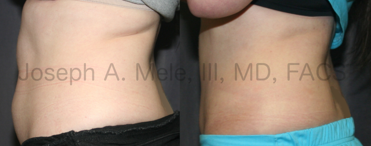 Lipo360 Liposuction before and after pictures - abdomen and back