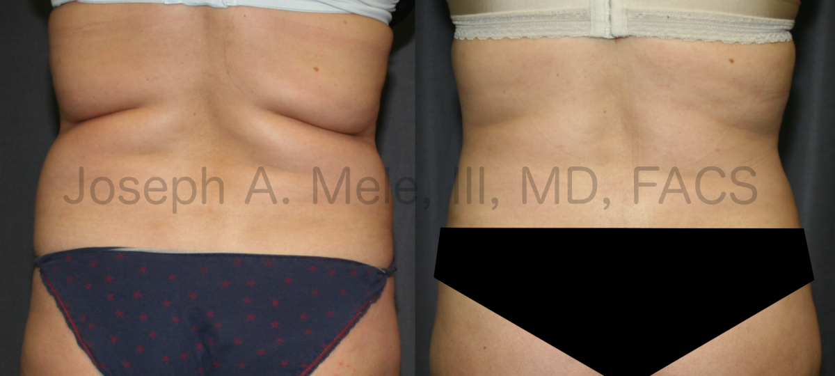 Lipo360 Liposuction before and after pictures - back