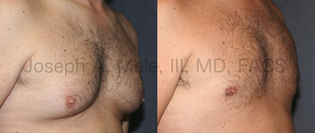 Lipo360 Liposuction before and after pictures - male chest gynecomastia