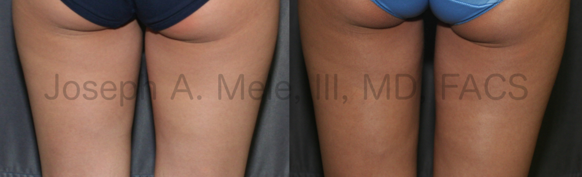 Lipo360 Liposuction before and after pictures - thighs