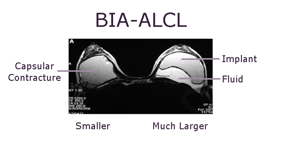 2022 BIA-ALCL Update