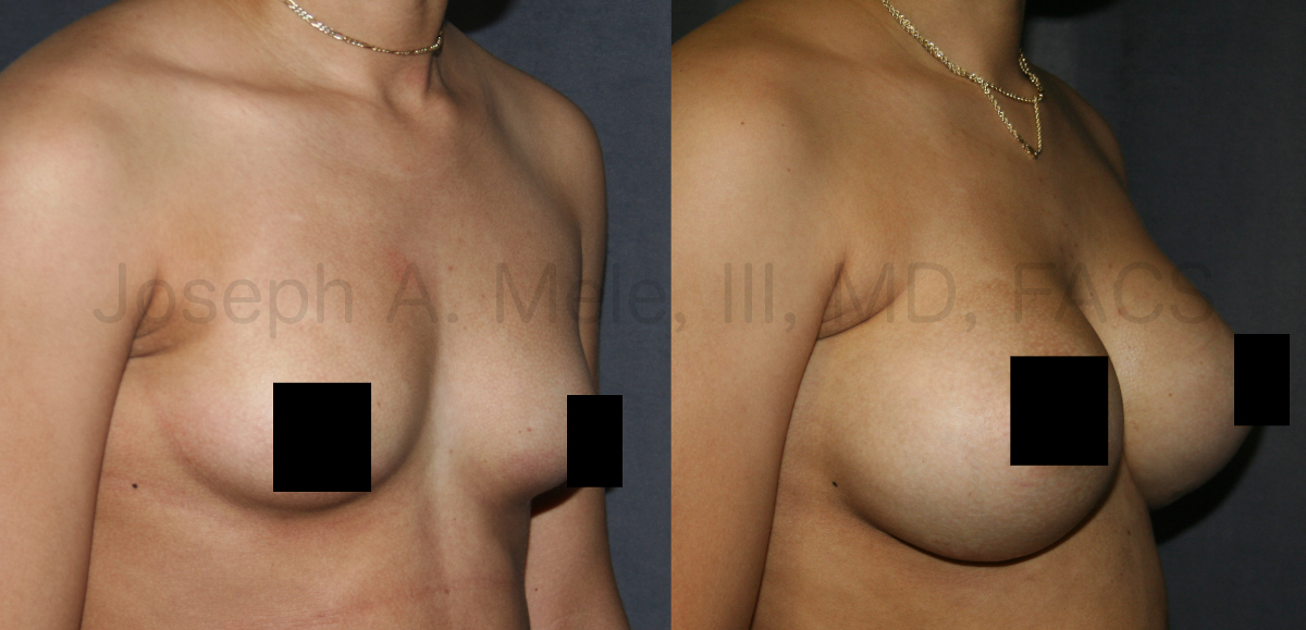 Gummy Bear Breast Implant Breast Augmentation Before and After Pictures (censored)