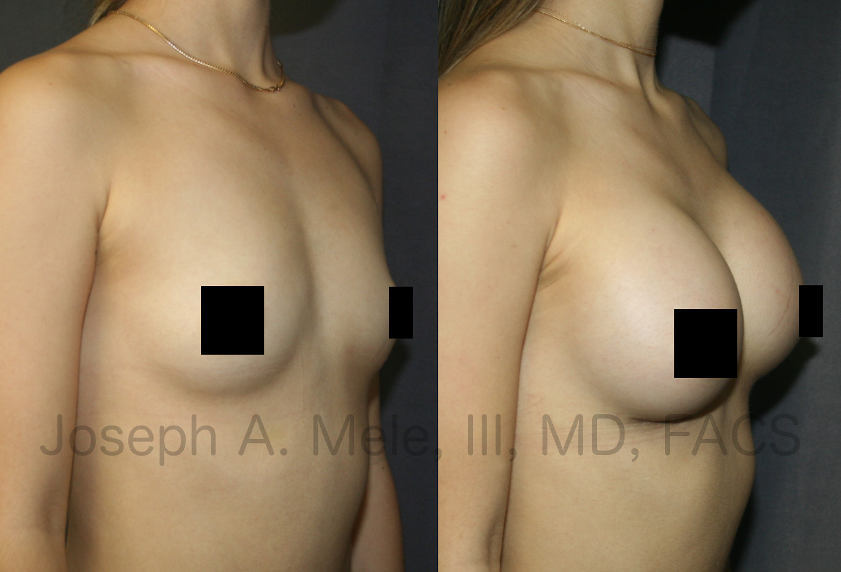 Gummy Bear Breast Implant Breast Augmentation Before and After Pictures (censored)