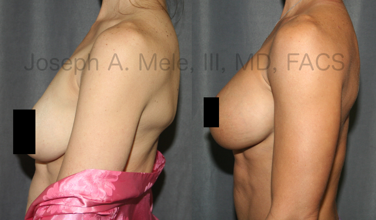 Gummy Bear Breast Implant Breast Augmentation Before and After Pictures (censored)