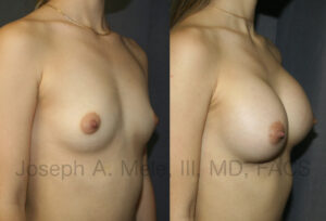 Gummy Bear Breast Implant Breast Augmentation Before and After Pictures (uncensored)
