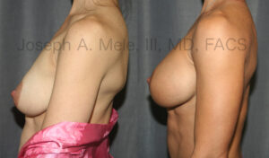 Gummy Bear Breast Implant Breast Augmentation Before and After Pictures (uncensored)