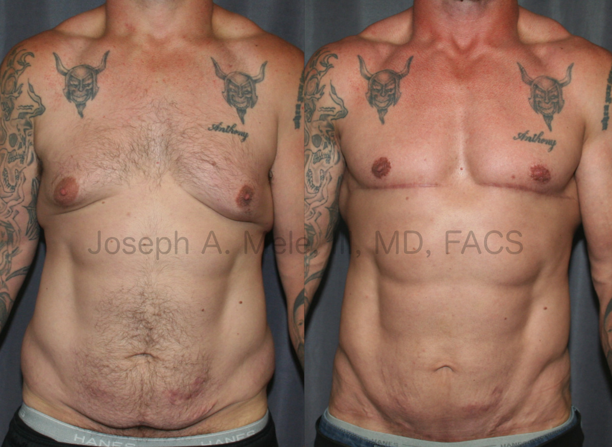 Daddy Makeover - Breast Reduction (Gynecomastia Reduction with Skin Excision) and Abdominoplasty (Tummy Tuck) Before and After Pictures