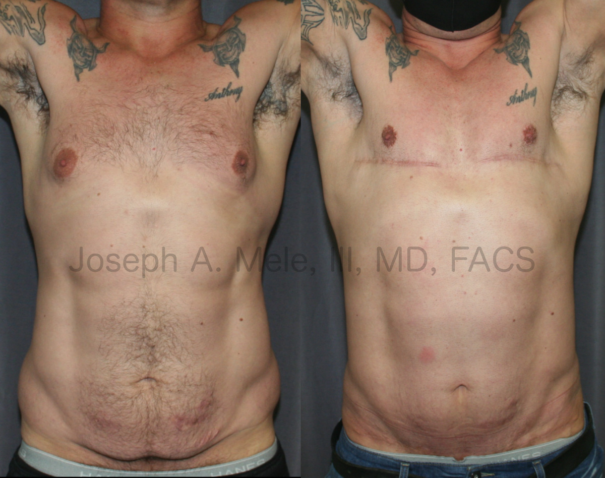 Daddy Makeover - Breast Reduction (Gynecomastia Reduction with Skin Excision) and Abdominoplasty (Tummy Tuck) Before and After Pictures