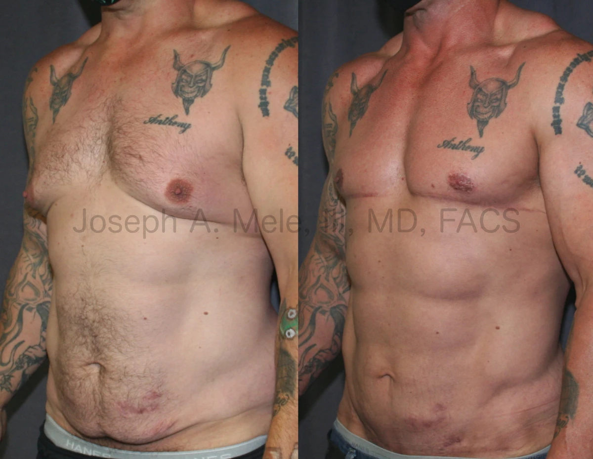 Daddy Makeover - Breast Reduction (Gynecomastia Reduction with Skin Excision) and Abdominoplasty (Tummy Tuck) Before and After Pictures