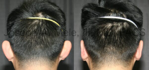 Otoplasty before and after photos - Ear Pinning
