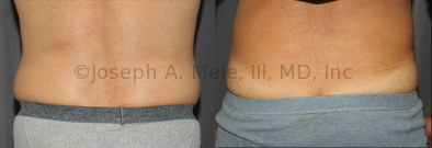 Liposuction Before and After Liposculpture Pictures