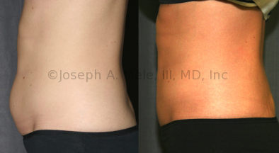 Liposuction Before and After Liposculpture Pictures