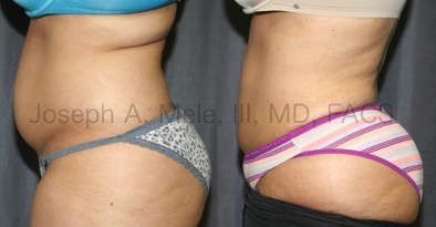 Liposuction Before and After Liposculpture Pictures
