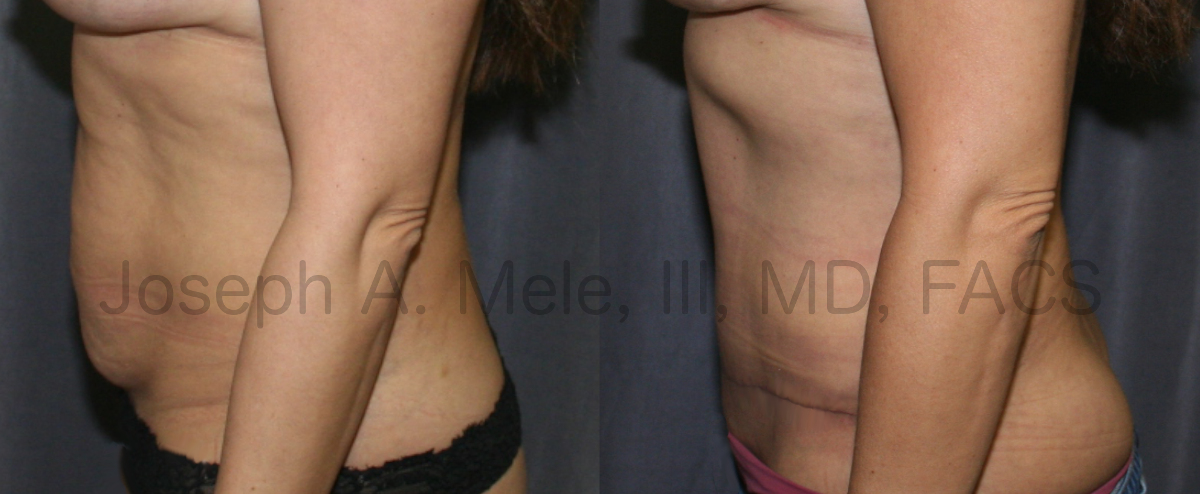 Abdominoplasty before and after photos Tummy Tuck