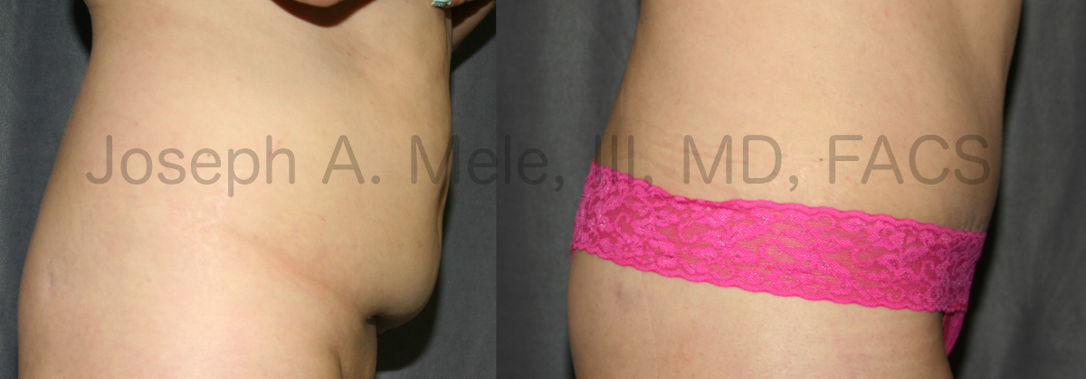 Tummy Tuck Fat Reduction before and after pictures