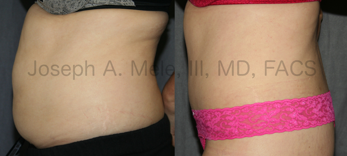 Tummy Tuck Muscle Tightening before and after pictures