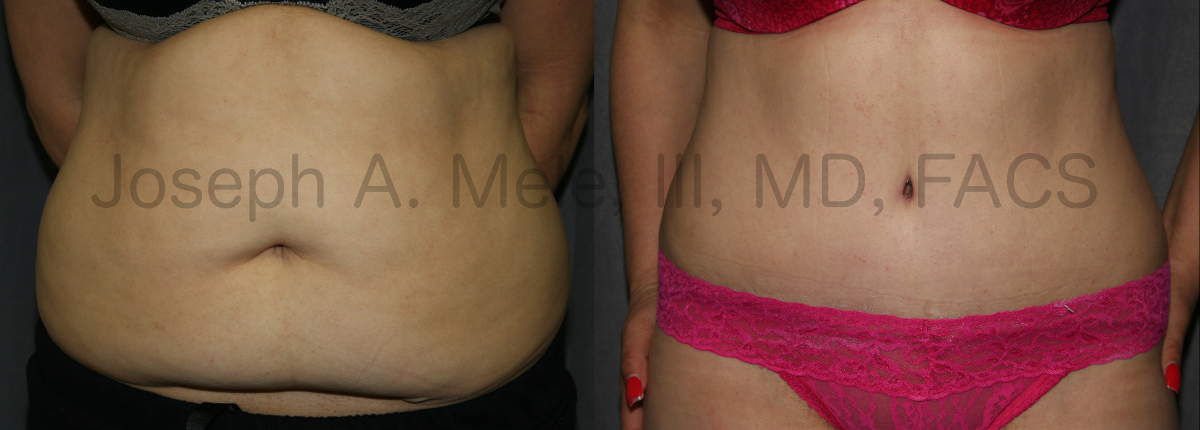 Tummy Tuck Skin Excision before and after pictures