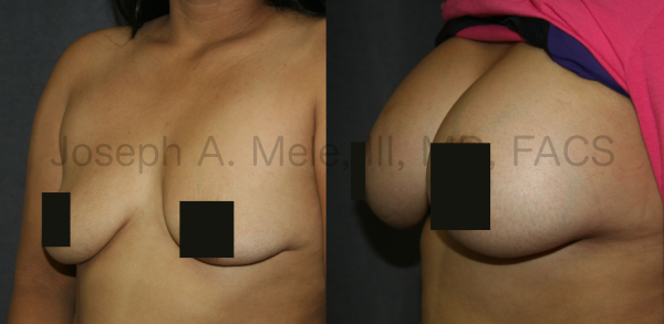 Breast Implant Replacement after breast implant exposure Before and After Pictures - Front View