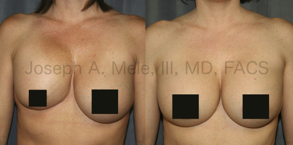 Breast Implant Revision for Capsular Contracture Before and After Pictures - Front View