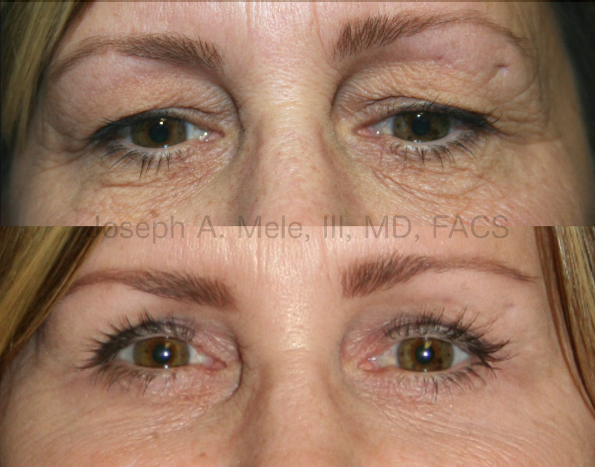 Eyelid Lift - Blepharoplasty