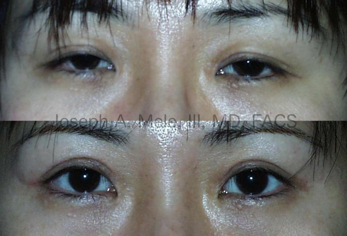 Asian Eyelid Lift - Blepharoplasty