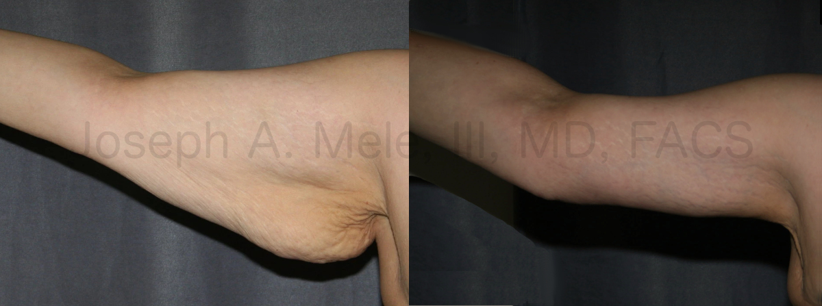 Brachioplasty Before and After Pictures (Arm Lift)